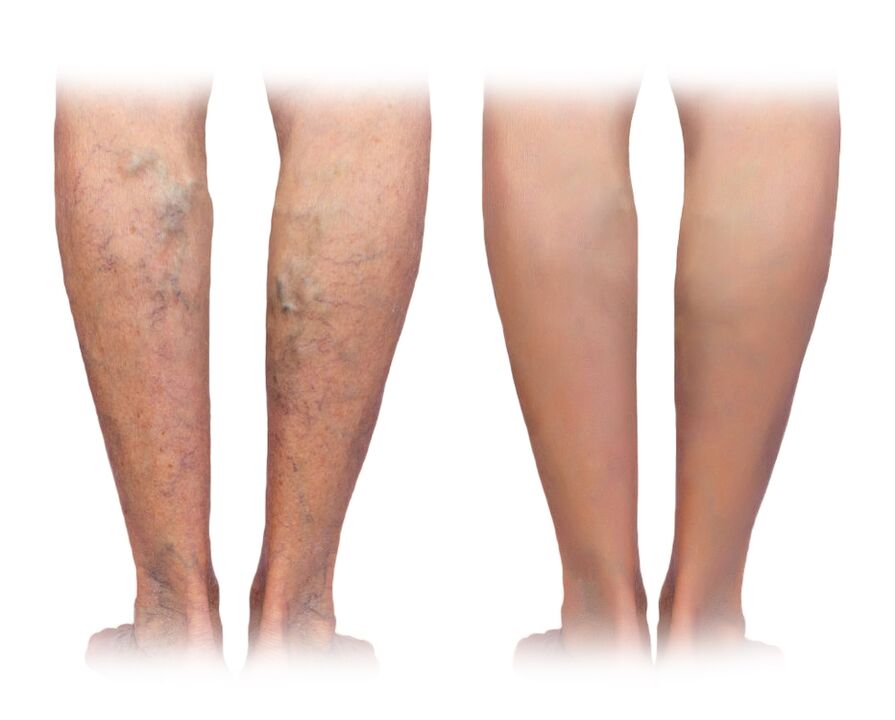 Piernas con varices antes y después de usar la crema Veniselle